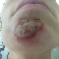 Như này có phải là bình thường sau khi điều trị bằng laser xung nhuộm màu không? Như này có phải là bình thường sau khi điều trị bằng laser xung nhuộm màu không?
