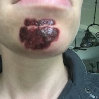 Như này có phải là bình thường sau khi điều trị bằng laser xung nhuộm màu không? Như này có phải là bình thường sau khi điều trị bằng laser xung nhuộm màu không?