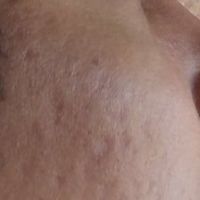 Laser xung nhuộm màu có giúp điều trị loại sẹo lõm của tôi không? Laser xung nhuộm màu có giúp điều trị loại sẹo lõm của tôi không?