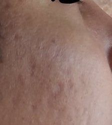 Laser xung nhuộm màu có giúp điều trị loại sẹo lõm của tôi không?