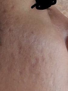 Laser xung nhuộm màu có giúp điều trị loại sẹo lõm của tôi không?