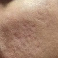 Laser xung nhuộm màu có giúp điều trị loại sẹo lõm của tôi không? Laser xung nhuộm màu có giúp điều trị loại sẹo lõm của tôi không?
