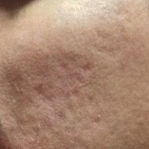 Laser xung nhuộm màu có giúp điều trị loại sẹo lõm của tôi không?