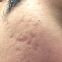Laser xung nhuộm màu có giúp điều trị loại sẹo lõm của tôi không? Laser xung nhuộm màu có giúp điều trị loại sẹo lõm của tôi không?