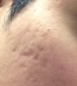 Laser xung nhuộm màu có giúp điều trị loại sẹo lõm của tôi không?