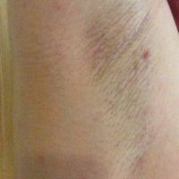 Triệt lông bằng laser GentleMax Pro Yag cho da sáng màu: có để lại sẹo không?