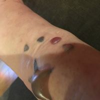 Bị phồng rộp như này một ngày sau lần đầu tiên xóa xăm bằng laser Picoway có ổn không?