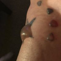 Bị phồng rộp như này một ngày sau lần đầu tiên xóa xăm bằng laser Picoway có ổn không?