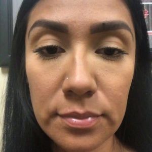 Với tình trạng của tôi thì nên lăn kim kết hợp bôi PRP hay tiêm PRP luôn?