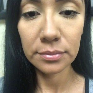 Với tình trạng của tôi thì nên lăn kim kết hợp bôi PRP hay tiêm PRP luôn?