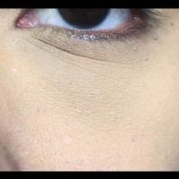 Với tình trạng của tôi thì nên lăn kim kết hợp bôi PRP hay tiêm PRP luôn?