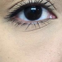 Với tình trạng của tôi thì nên lăn kim kết hợp bôi PRP hay tiêm PRP luôn?