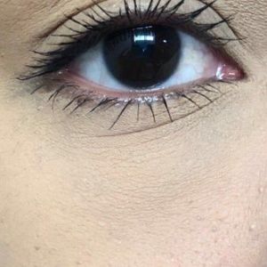 Với tình trạng của tôi thì nên lăn kim kết hợp bôi PRP hay tiêm PRP luôn?