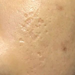 Picosure có hiệu quả khi điều trị sẹo rỗ do mụn không?