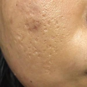 Picosure có hiệu quả khi điều trị sẹo rỗ do mụn không?