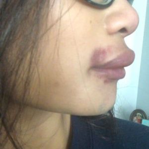 Môi trên sưng to sau khi tiêm Restylane có bình thường không? Tôi đang lo bị biến chứng