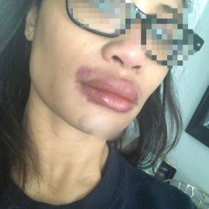 Môi trên sưng to sau khi tiêm Restylane có bình thường không? Tôi đang lo bị biến chứng