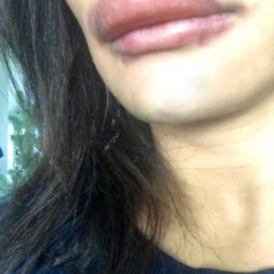 Môi trên sưng to sau khi tiêm Restylane có bình thường không? Tôi đang lo bị biến chứng