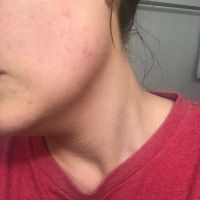 Bị sưng đỏ sau lần đầu điều bằng Picoway? Bị sưng đỏ sau lần đầu điều bằng Picoway?