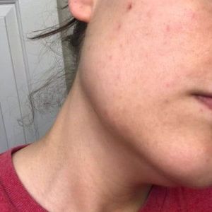 Bị sưng đỏ sau lần đầu điều bằng Picoway?