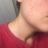 Bị sưng đỏ sau lần đầu điều bằng Picoway?