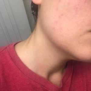 Bị sưng đỏ sau lần đầu điều bằng Picoway?