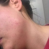 Bị sưng đỏ sau lần đầu điều bằng Picoway?