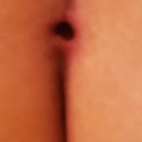 Vết mổ đặt túi độn mông bị hở và rỉ dịch sau hơn 3 tháng, phải làm gì?