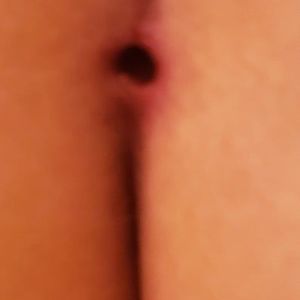 Vết mổ đặt túi độn mông bị hở và rỉ dịch sau hơn 3 tháng, phải làm gì?