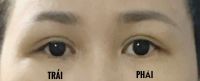 Cắt mí được 20 ngày nhưng bị không đều