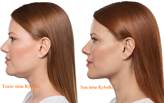 AboutKybella