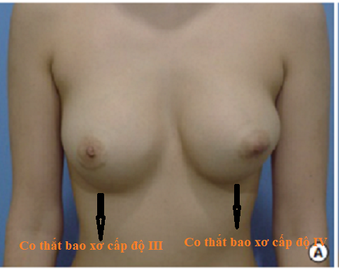 ảnh cấp độ co thắt