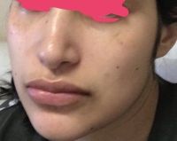 Bellafill so với Sculptra?