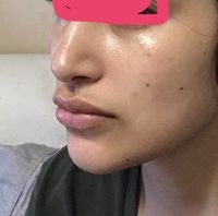 Bellafill so với Sculptra? Bellafill so với Sculptra?