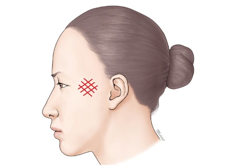 căng da bằng chỉ kỹ thuật