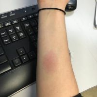 Đây có phải phản ứng dị ứng da dương tính với Bellafill không? (Hình ảnh)