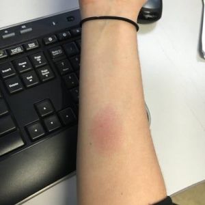 Đây có phải phản ứng dị ứng da dương tính với Bellafill không? (Hình ảnh)