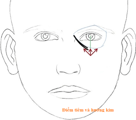 điểm tiêm và hướng kim tiêm 1