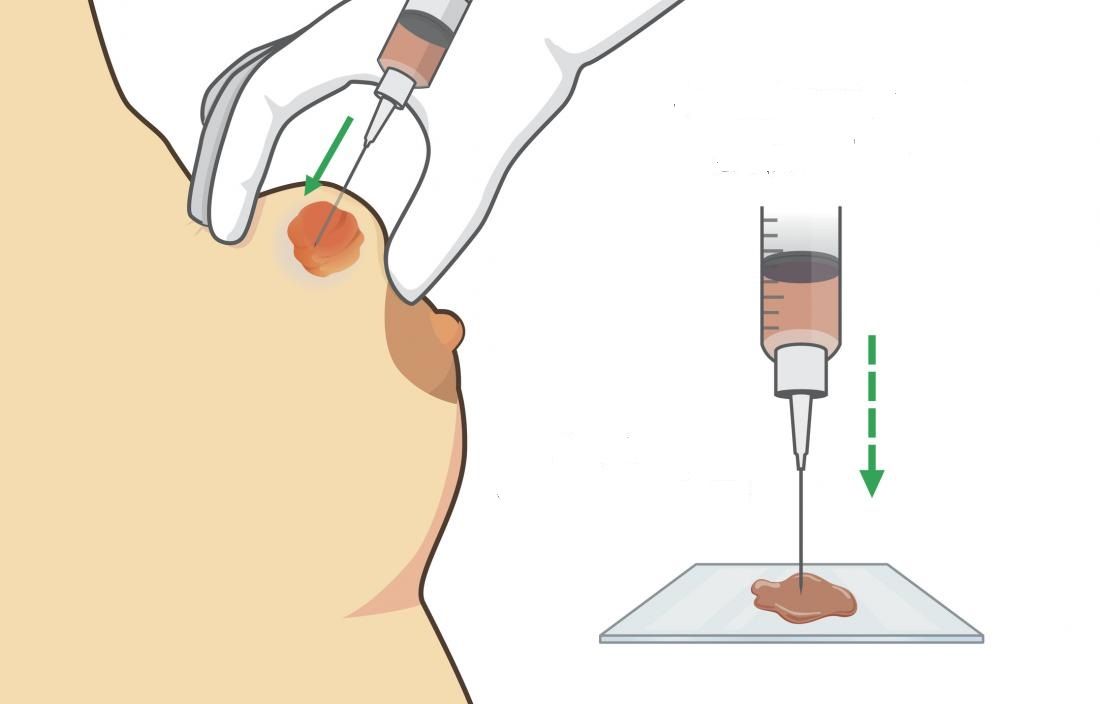 fine needle aspiration