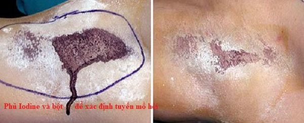 hyperhidrosis dr maletic