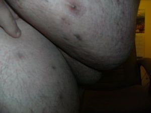 Nhiều mỡ chảy xệ ở vùng mu thì phải làm sao?