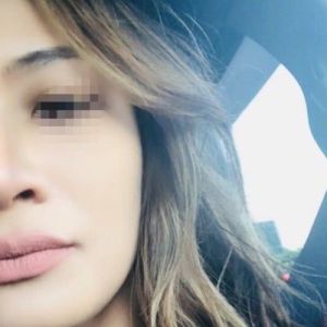 Môi trên sưng to sau khi tiêm Restylane có bình thường không? Tôi đang lo bị biến chứng