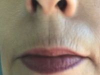 Tiêm Bellafill vào đường viền môi trên hay tái tạo bề mặt da?