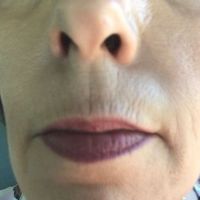 Tiêm Bellafill vào đường viền môi trên hay tái tạo bề mặt da?