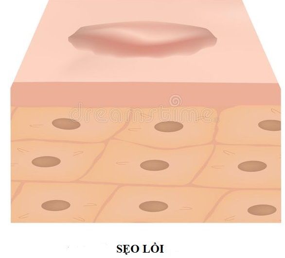 scars keloid anatomical structure skin scar vector illustration isolated background scars keloid anatomical 167070667