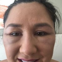 Tiêm Bellafill vào dưới và quanh 2 mắt, 48 giờ sau, sưng tấy trở nên tồi tệ hơn. Như thế có bình thường không?