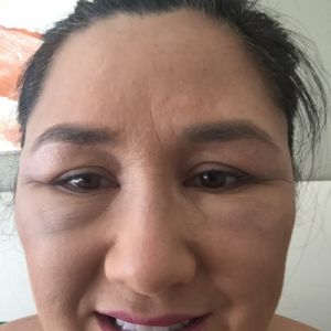 Tiêm Bellafill vào dưới và quanh 2 mắt, 48 giờ sau, sưng tấy trở nên tồi tệ hơn. Như thế có bình thường không?