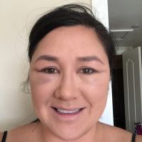 Tiêm Bellafill vào dưới và quanh 2 mắt, 48 giờ sau, sưng tấy trở nên tồi tệ hơn. Như thế có bình thường không?