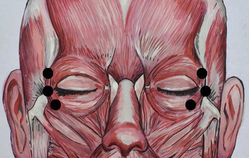 tiêm botox 2
