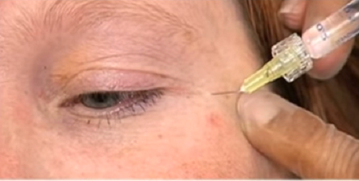tiêm filler